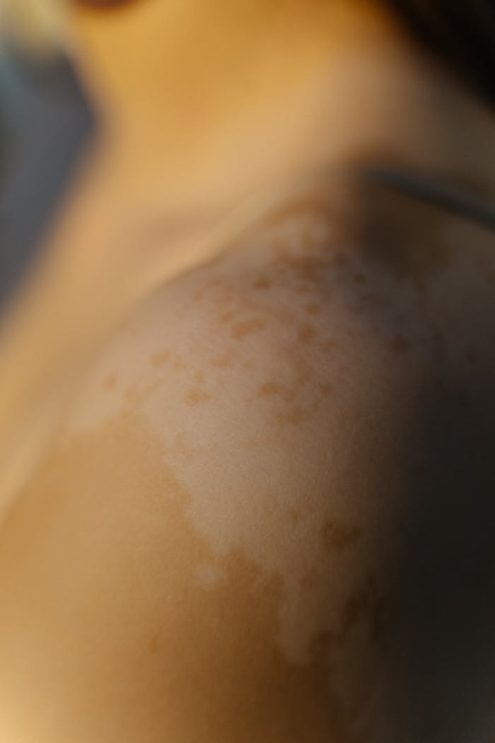 Intimate close-up of a person's shoulder with noticeable skin discoloration and vitiligo patches, highlighting natural beauty.